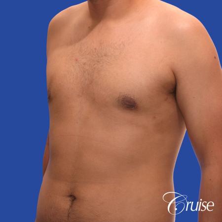 mild gynecomastia standard PA areola incision - After Image 3