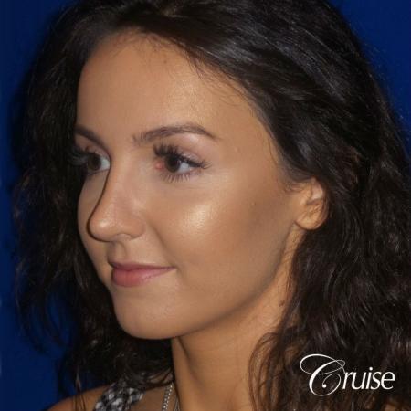 Rhinoplasty Dr. Cruise newport beach - After Image 4