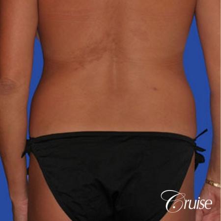mommy makeover with best breast lift anchor with saline implants - Before and After Image 5