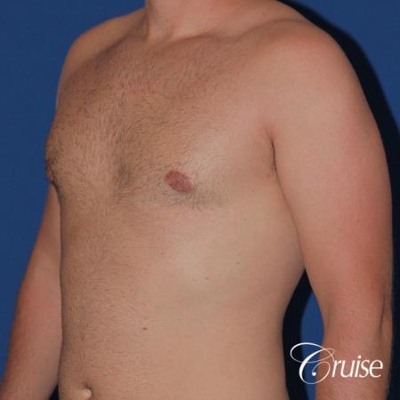 best puffy nipple surgery correction - After Image 3