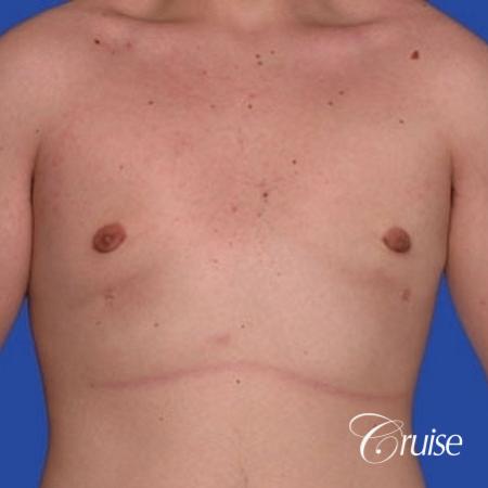 mild gynecomastia with puffy nipple from puberty - After Image 1