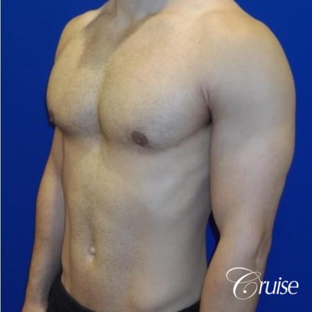 gynecomastia correction newport beach - After 3