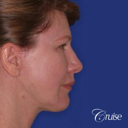 52 year old with chin augmentation and facelift - After Image 3