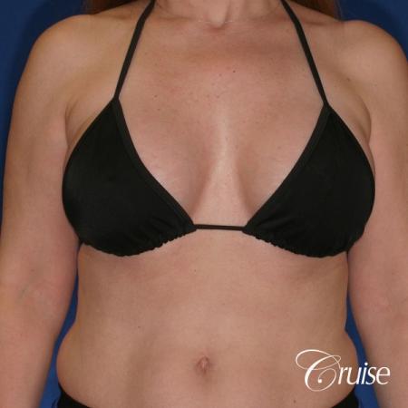 best breast lift donut scars in Newport Beach - After Image 3