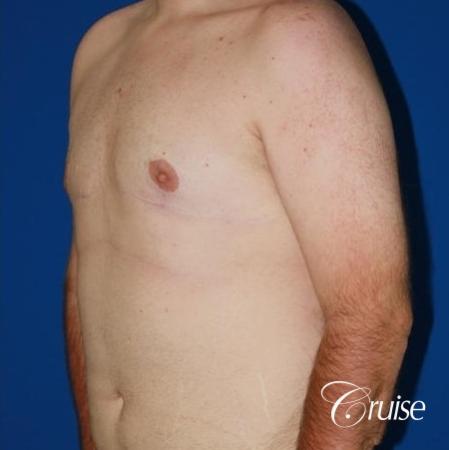 moderate gynecomastia with pointy man boobs - After Image 3