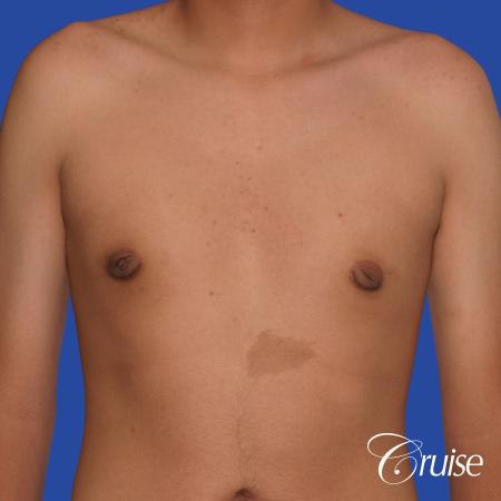 gynecomastia patient gets nipple reduction for best results - After Image 1