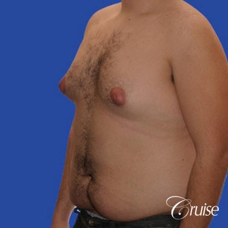 male liposuction abdomen flanks with Gynecomastia - Before Image 3