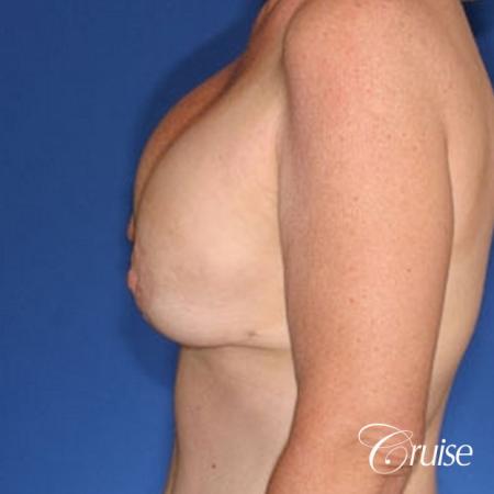bilateral capsular contracture silicone - Before Image 2