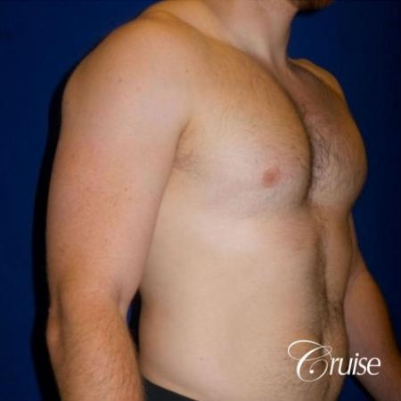 Dr. Cruise gynecomastia surgery photos - After Image 2