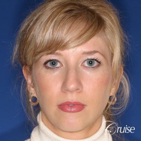 female patient with best chin implant scar - Before Image 1
