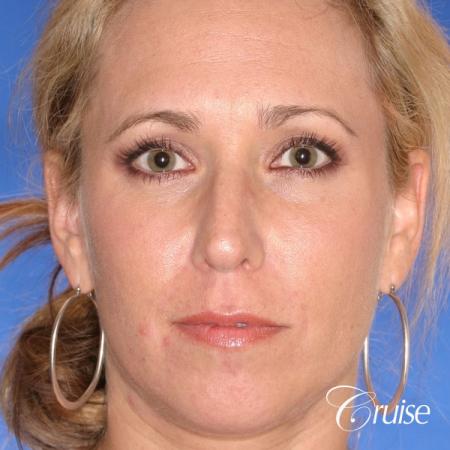 female with natural looking chin implant - Before Image 1