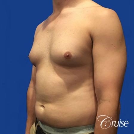 gyne before and after photos orange county ca - Before Image 2