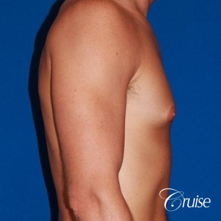 mild gyne on athletic adult - Before and After Image 2