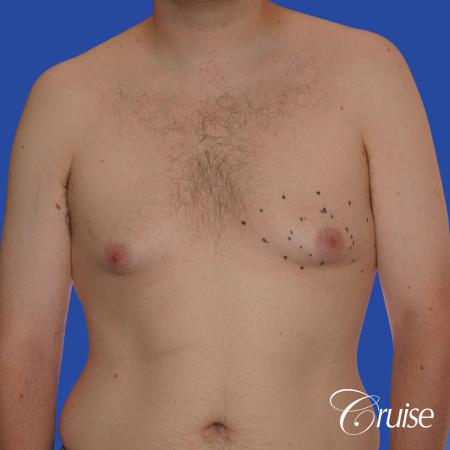 moderate gyne on 31 yr old male - Before Image 1