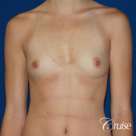 Breast Augmentation - Before Image 1