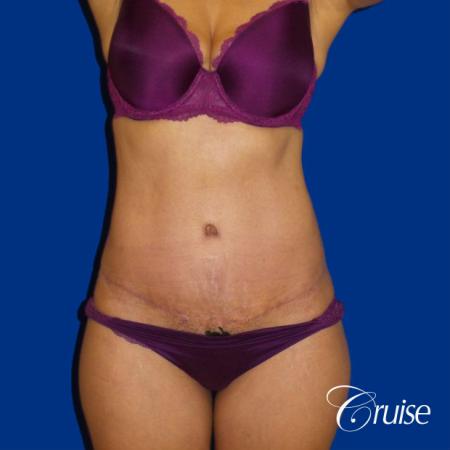 tuck tummy incision extended before