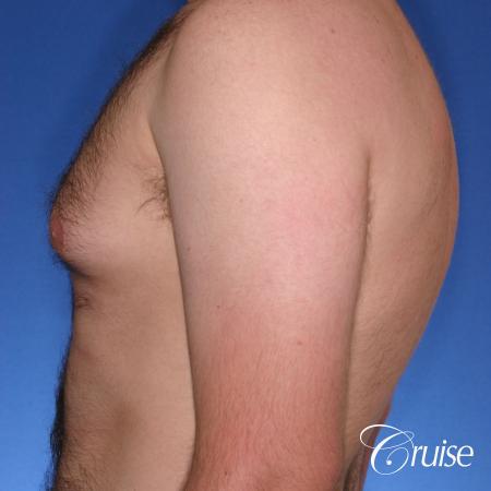 best Puffy nipple correction and gynecomastia on young adult - Before Image 2