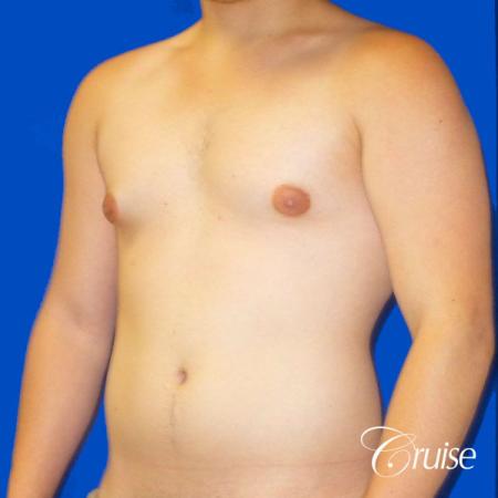 Best Gynecomastia surgeons Southern California - Before Image 3