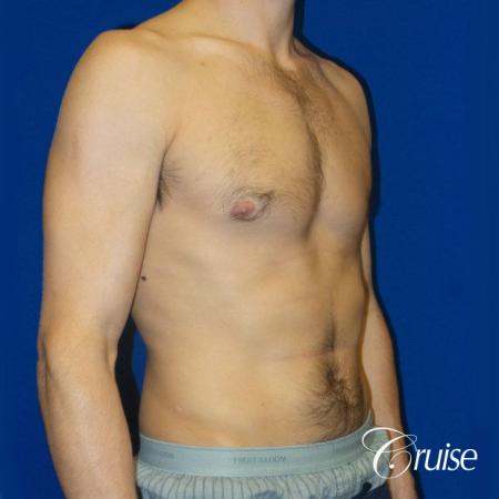 Unilateral gynecomastia - After Image 2