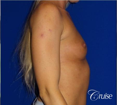 Breast Augmentation - Before and After Image 3