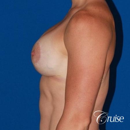 best breast lift anchor on athletic body type - After Image 3