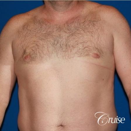 mild puffy nipple on 42 year old - After Image 1