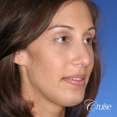 29 yr old with large female chin augmentation - After Image 3