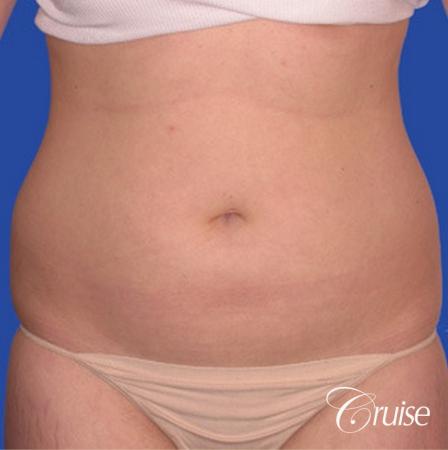 best skinny abs from liposuction abdomen and flanks - Before Image 1