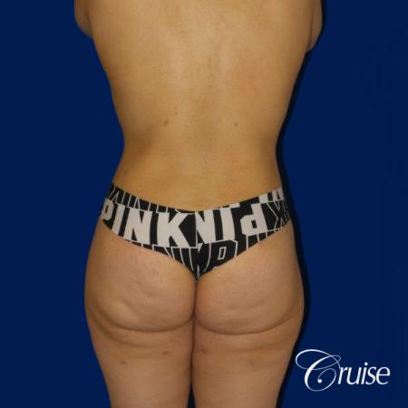 Extended Tummy Tuck, BBL, Breast Lift Anchor With Silicone - After 4
