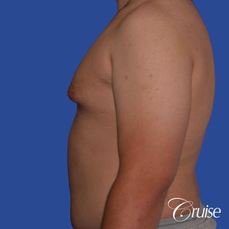 best scars for moderate gynecomastia - Before Image 2