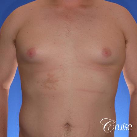 moderate gyne on teen with best pictures - Before Image 1