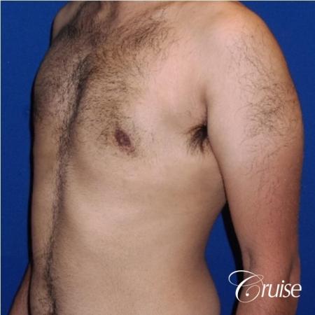 Moderate Gynecomastia Areola Incision - After Image 3