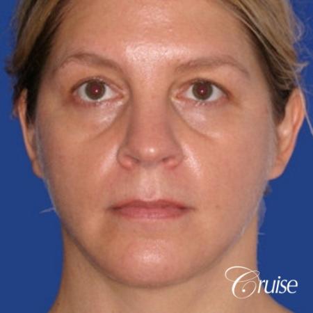 female who got large chin implant in Newport Beach - After Image 1