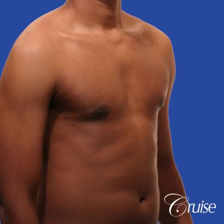 young body builder has puffy nipple and gets gynecomastia surgery - After Image 4