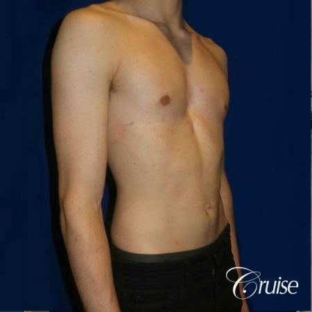 Top Gynecomastia Specialist Dr. Cruise - After Image 5