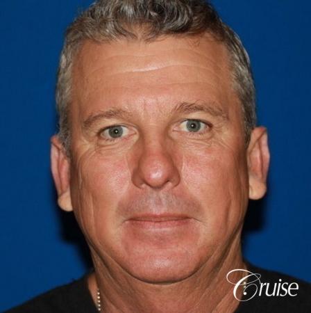 best pictures of otoplasty on male adult - After Image 1