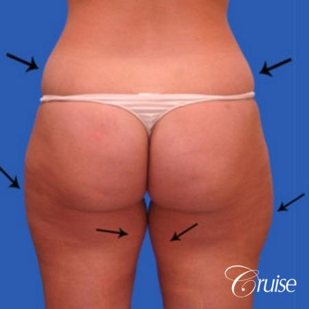 best liposuction abdomen flanks medial and lateral thighs dramatic - Before and After Image 3