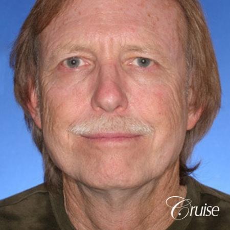 62 yr old with medium square chin augmentation - Before Image 1