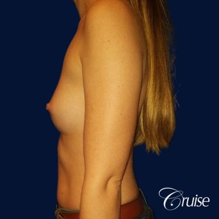 Breast Augmentation - Before and After Image 3