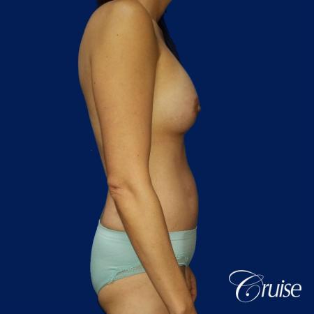 Best Tummy Tuck before and afters Dr. Cruise - After Image 4