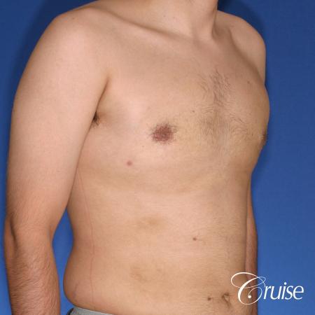moderate gynecomastia puffy nipple - After Image 4