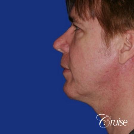 male with best scar for chin implant - After Image 2