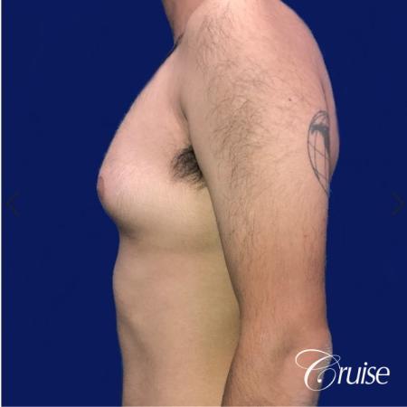 Moderate Gynecomastia Areola Incision - Before Image 2