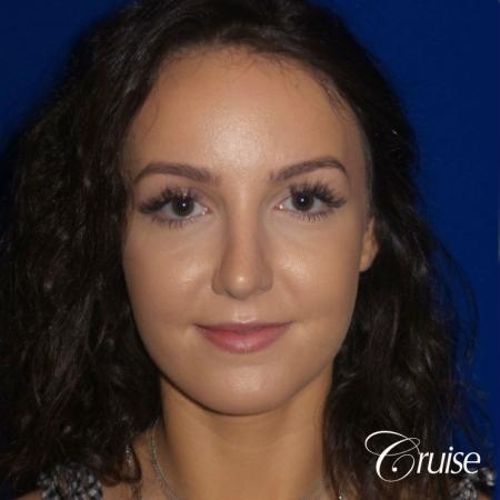 Rhinoplasty Dr. Cruise newport beach - After Image 1