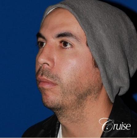 male patient with large chin augmentation - Before Image 3