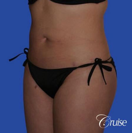 best pictures of liposuction with plastic surgeon in Newport Beach - After Image 2