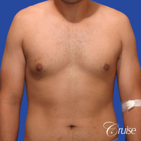 mild gynecomastia standard PA areola incision - Before Image 1