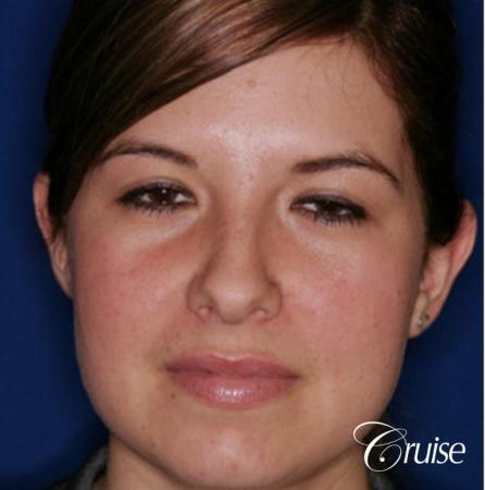 best otoplasty on adolescent - Before Image 1