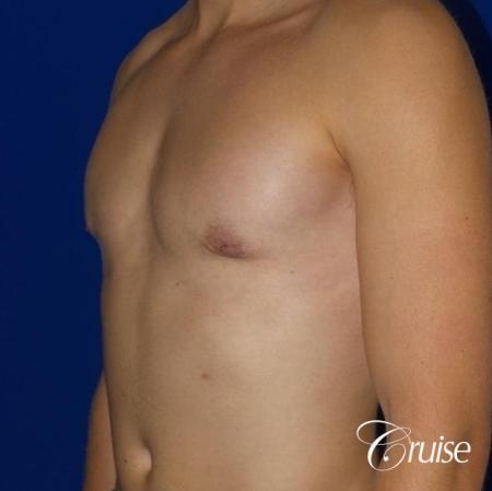 Mild Gynecomastia -Areola Incision - After Image 2
