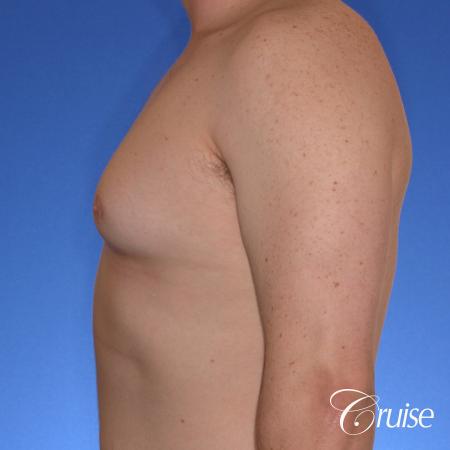 moderate gyne on teen with best pictures - Before Image 2